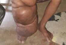 हत्तीरोगापासून दूर राहण्यासाठी गोळ्या घ्या, घरोघरी वाटपाची मोहीम सुरू